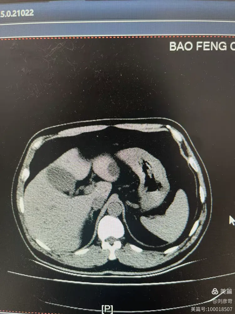 腹部ct平扫及增强,胃肠道准备的重要性